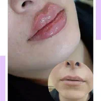 تزریق ژل و بوتاکس|خدمات آرایشگری و زیبایی|بیرجند, |دیوار