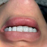 زیبایی دندان با قیمت مناسب و کیفیت بالا|خدمات آرایشگری و زیبایی|تهران, سازمان برنامه شمالی|دیوار