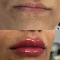 خدمات تزریق ژل و بوتاکس|خدمات آرایشگری و زیبایی|مشهد, عسگریه|دیوار