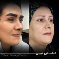 کلینیک فوق تخصصی/کاشت مو / ابرو|خدمات آرایشگری و زیبایی|زاهدان, |دیوار