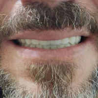 ساخت تخصصی دندان مصنوعی(دندانسازی) (اقساط 6 ماه)|خدمات آرایشگری و زیبایی|قم, شاه ابراهیم|دیوار
