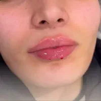 تزریق ژل و بوتاکس همه روزه حتی ایام تعطیلات
