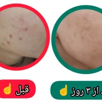 محلول ضدجوش و آکنه گیاهی|آرایشی، بهداشتی، درمانی|کاشمر, |دیوار