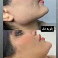 تخفیفات آنزیم بوتاکس صورت فیلر فول فیس و...|خدمات آرایشگری و زیبایی|مشهد, شهید فرامرز عباسی|دیوار