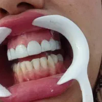 تخفیفات ویژه کامپوزیت در درمانگاه تخصصی یاسوج|خدمات آرایشگری و زیبایی|یاسوج, |دیوار