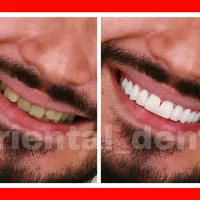 بریج و کامپوزیت و لیفت لثه جرمگیری دندان عصبکشی|خدمات آرایشگری و زیبایی|تهران, تهرانپارس غربی|دیوار