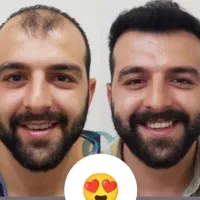 کاشت مو