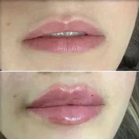 ژل بوتاکس بلفافیشیال اصلاح بخور خالبرداری اپلاسیون