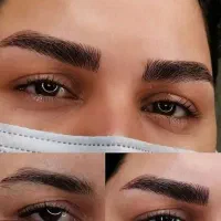 میکروبلیدینگ+فیبروز