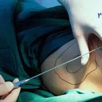 لیپوساکشن،غبغب پیکرتراشی و تزریق اقساطی توسط پزشک