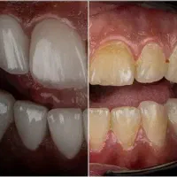 دندانپزشکی اقساطی ۱۱ ماهه با تخفیف ۲۰ درصد