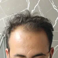 کاشت موی طبیعی فول تراکم|خدمات آرایشگری و زیبایی|ساری, |دیوار