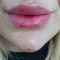 جشنواره تزریق ژل و بوتاکس زیر قیمت همه جا|خدمات زیبایی و سلامت|تهران, ائمه اطهار|دیوار