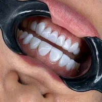 عصب کشی و ترمیم