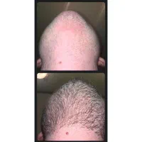 پرپشتی ریش بدون کاشت و خون ریزی|آرایشی، بهداشتی، درمانی|مرودشت, بیست متری بیمارستان|دیوار