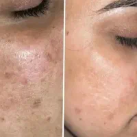 تخفیفات آموزش مزوژل و مزو کوکتل