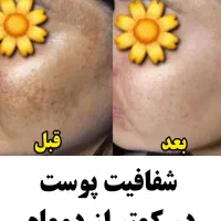 پک های بهبود کبد چرب / رفع لک / قطع ریزش مو