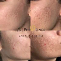 رفع تخصصی جای جوش