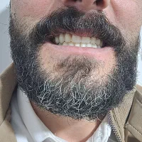 دندانسازی متحرک(شرایط خوب)