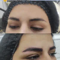 خدمات میکرو بلیدینگ (فیبروز) با قیمت مناسب در زهک
