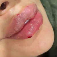 کیلینیک نیولایف لیزر بانوان ۳۰۰ آقایان ۶۰۰