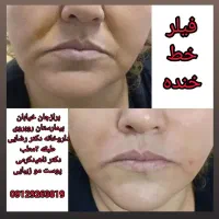 جوانسازی ژل و مزوژل و..|خدمات آرایشگری و زیبایی|برازجان, |دیوار