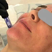 مزونیدلینگ صورت(جوان‌سازی،برطرف کردن جای جوش و لک)|خدمات آرایشگری و زیبایی|بابل, |دیوار