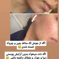 ضد اکنه|آرایشی، بهداشتی، درمانی|شیراز, آبیاری|دیوار