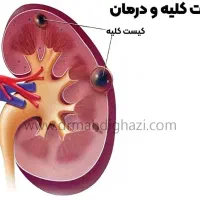 درمان سنگ کلیه
