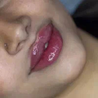 تزریق ژل و بوتاکس۶۹۹تومن