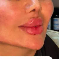 ژل لب و بوتاکس