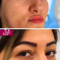 بلفاروپلاستی توسط متخصص چشم با بخیه سوپرنانو لیزری|خدمات آرایشگری و زیبایی|تهران, جردن|دیوار