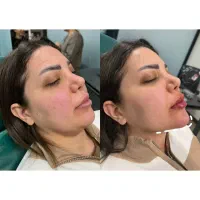 ژل ،بوتاکس،مزوتراپی مو، خال برداری ،لیزر مو|خدمات آرایشگری و زیبایی|اسلام‌شهر, باغ فیض|دیوار