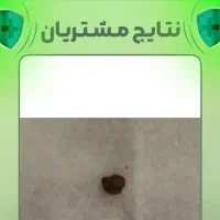 یه روغن گیاهی و خوردنی برای دفع سنگ‌کلیه