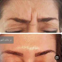 تزریق بوتاکس و ژل