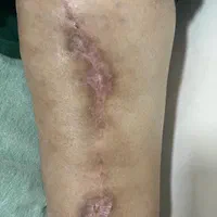 مشاوره و بورد تخصصی درمان زخم (در کلینیک و منزل)