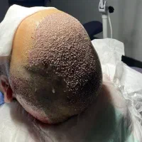کاشت مو پرتراکم و تضمینی فقط ۱۵ میلیون|خدمات آرایشگری و زیبایی|تهران, جردن|دیوار