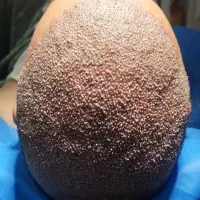 نیازمند یک مدل کاشت مو