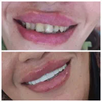 کامپوزیت دندان با بهترین کفیت با قیمتی مناسب|خدمات آرایشگری و زیبایی|یاسوج, |دیوار