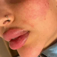 تزریق ژل و بوتاکس در هشتگرد