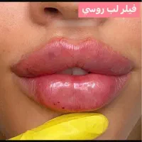 جشنواره ژل و بوتاکس و مزوژل|خدمات آرایشگری و زیبایی|تهران, ظفر|دیوار