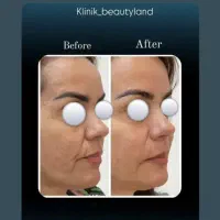 هایفو تراپی جوانسازی فقط سالی یکبار نتیجه انی