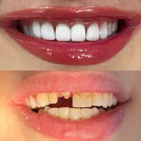 ونیر کامپوزیت ژاپنی اصل (تعرفه دولتی + اقساط)|خدمات آرایشگری و زیبایی|علیآباد کتول, |دیوار