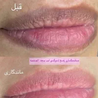 رفع تیرگی لب