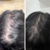پاکسازی سر،موخوره گیری،اسکالپ،درمان ریزش،رویش مجدد|خدمات آرایشگری و زیبایی|قم, هفت تیر|دیوار