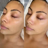 کربن تراپی ،پیلینگ هالیوودی،ریمو تتو صورت و بدن|خدمات آرایشگری و زیبایی|شیراز, فرهنگ شهر|دیوار