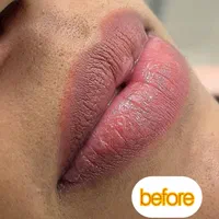 ژل و بوتاکس مرو فیلر توسط دکتر تخفیف ۳۰ ٪|خدمات آرایشگری و زیبایی|مشهد, کوثر|دیوار