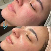 جای جوش و لک رو به پوست صافتر تبدیل کن|خدمات زیبایی و سلامت|اصفهان, وحید|دیوار