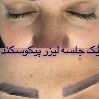 رفع تیرگی بدن حذف تتو صورت و بدن. کربن تراپی|خدمات آرایشگری و زیبایی|تربت‌حیدریه, کاشانی|دیوار