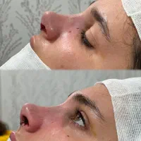 جراحی بینی دراهوازفقط۲۵ت توسط بهترین جراح اف